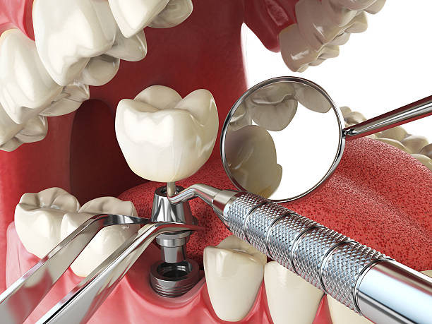 Best Emergency Dentist for Knocked-Out Tooth in Church Hill, MD